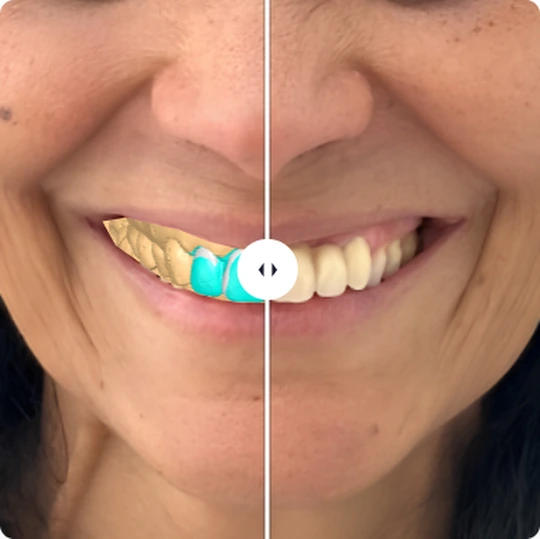 Before and after: the planned teeth over the real smile